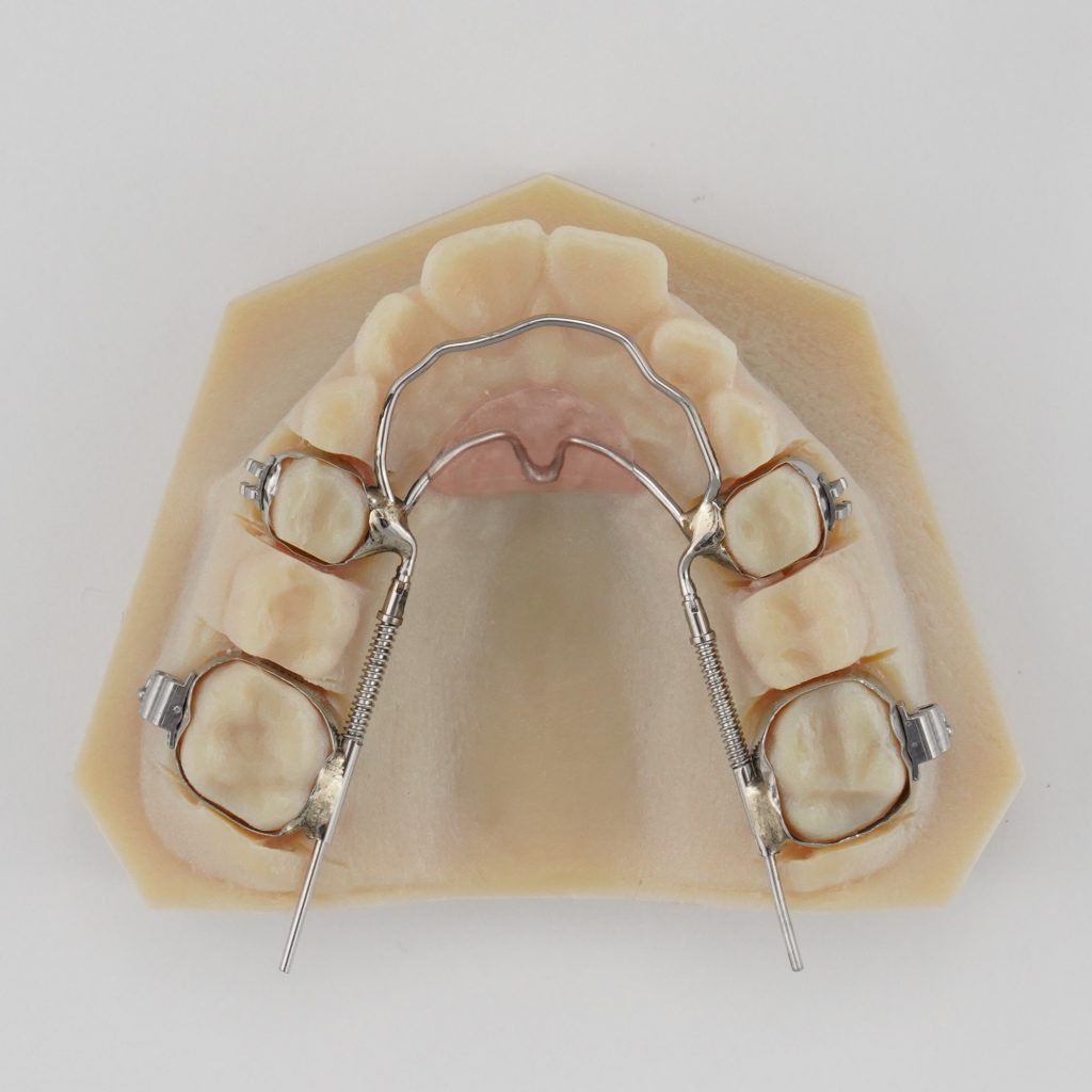 Inman Distalizer