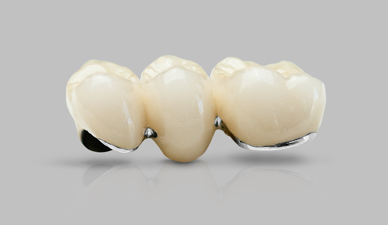 Porcelain Fused to Metal